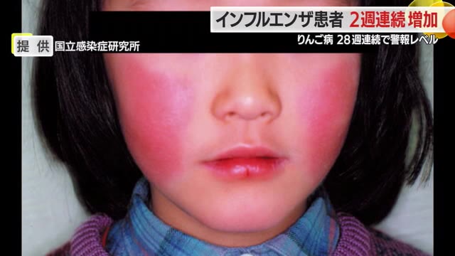＜感染症＞リンゴ病の患者数78人（前週比-13人）も警報レベル継続・インフルエンザの患者数も増　山形 画像