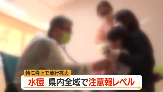 子どもに多い水痘（水ぼうそう）流行・3カ月ぶり注意報レベル　県全体で1.24人・最上4.0人　山形 画像