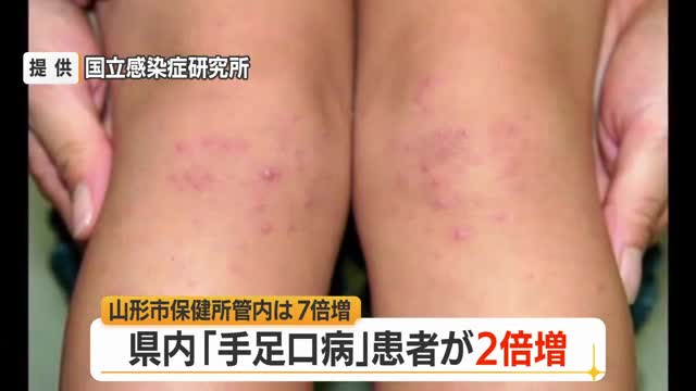 【感染症／山形】手足口病の患者急増105人（前週比+52人）　庄内・山形市保健所管内で警報レベル 画像
