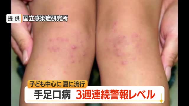 3週連続の警報レベル・手足口病の患者数391人　ひまつ・便から感染...こまめな手洗いを　山形 画像