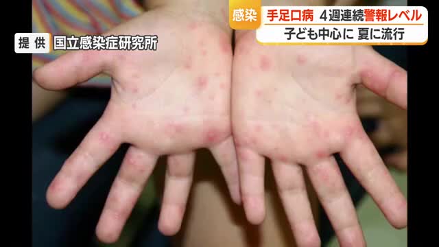 手足口病・患者数315人（前週比-76人）も4週連続警報レベル　タオル共用避けこまめな手洗いを　山形 画像