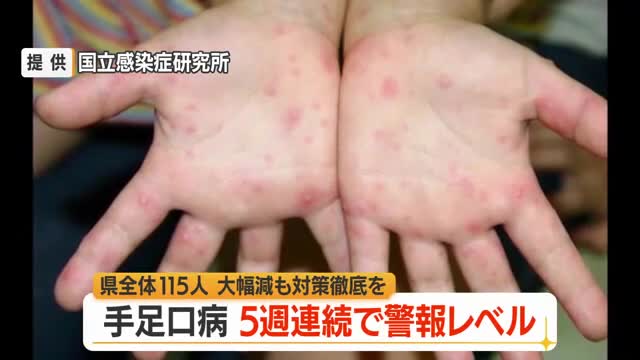 5週連続で警報レベル・手足口病の患者数115人（前週比-200人）　5歳以下の子ども中心に流行　山形 画像