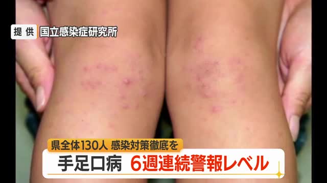 6週連続警報レベル・手足口病患者数130人（前週比+15人）　タオル共用避けこまめに手洗いを　山形 画像